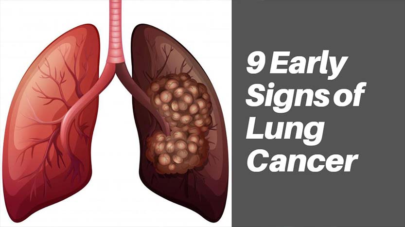 9 Early Signs of Lung Cancer