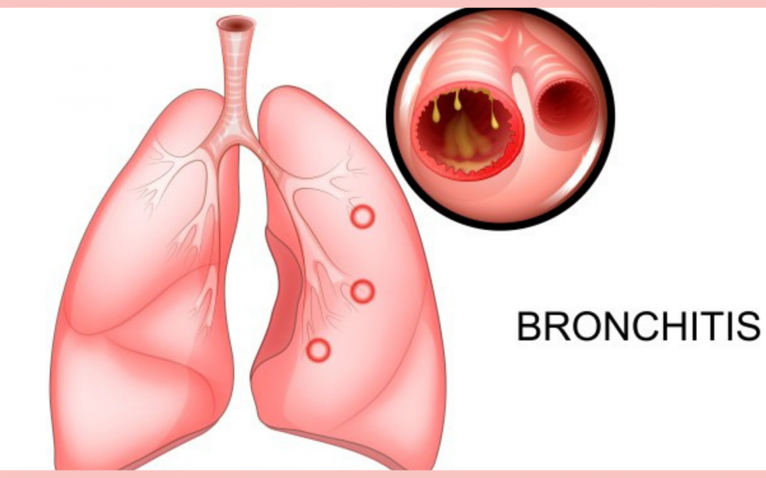 Bronchitis Symptom, Signs, and Complications
